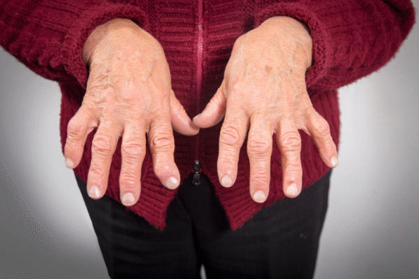 Arthritis
