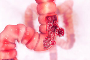 penyakit kanker usus