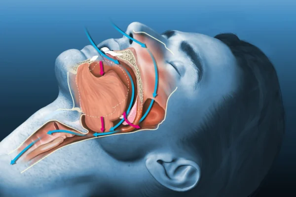 sleep apnea