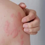 Alergi Debu: Gangguan Kecil yang Bisa Bikin Tidak Nyaman alergi debu