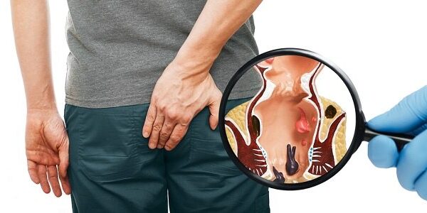 Fakta Menarik Tentang Penyakit Hemoroid yang Jarang Diketahui penyakit hemoroid