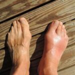 Asam Urat: Saat Sendi Tiba-Tiba Nyeri dan Sulit Digunakan asam urat