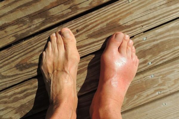 Mengenal Penyakit Asam Urat dan Cara Mengendalikannya asam urat