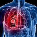 Mengenal Lebih Dekat Emfisema dan Cara Kerjanya emfisema