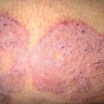 Gatal Kulit: Masalah Sepele yang Bisa Jadi Gangguan Serius gatal kulit