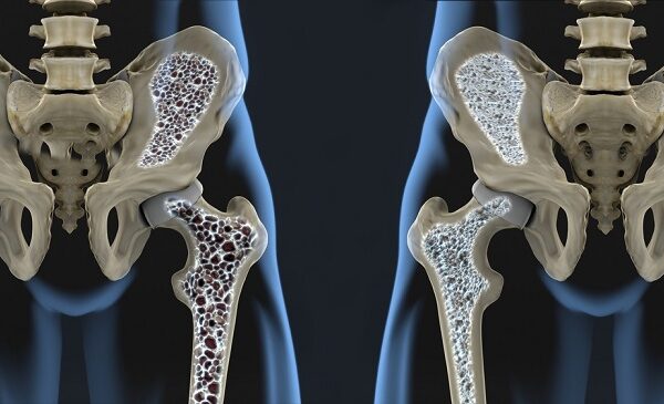 Mengenal Osteoporosis dan Cara Menjaga Kekuatan Tulang Sejak Dini osteoporosis
