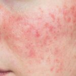 Jerawat Kronis: Masalah Kulit yang Tak Kunjung Pergi jerawat kronis