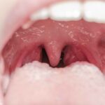 tonsilitis