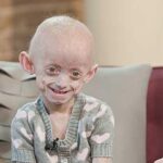 Progeria