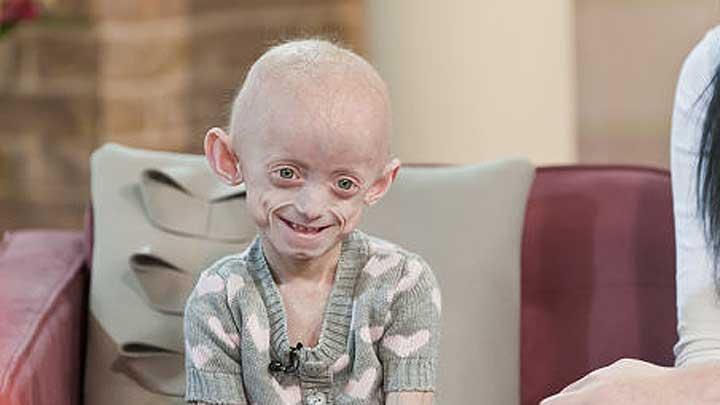 Progeria