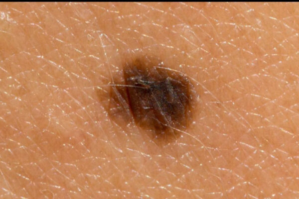 Melanoma