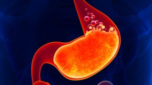 penyakit asam lambung