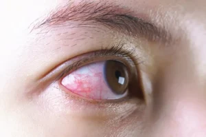 penyebab mata merah