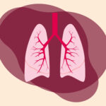 pneumonia
