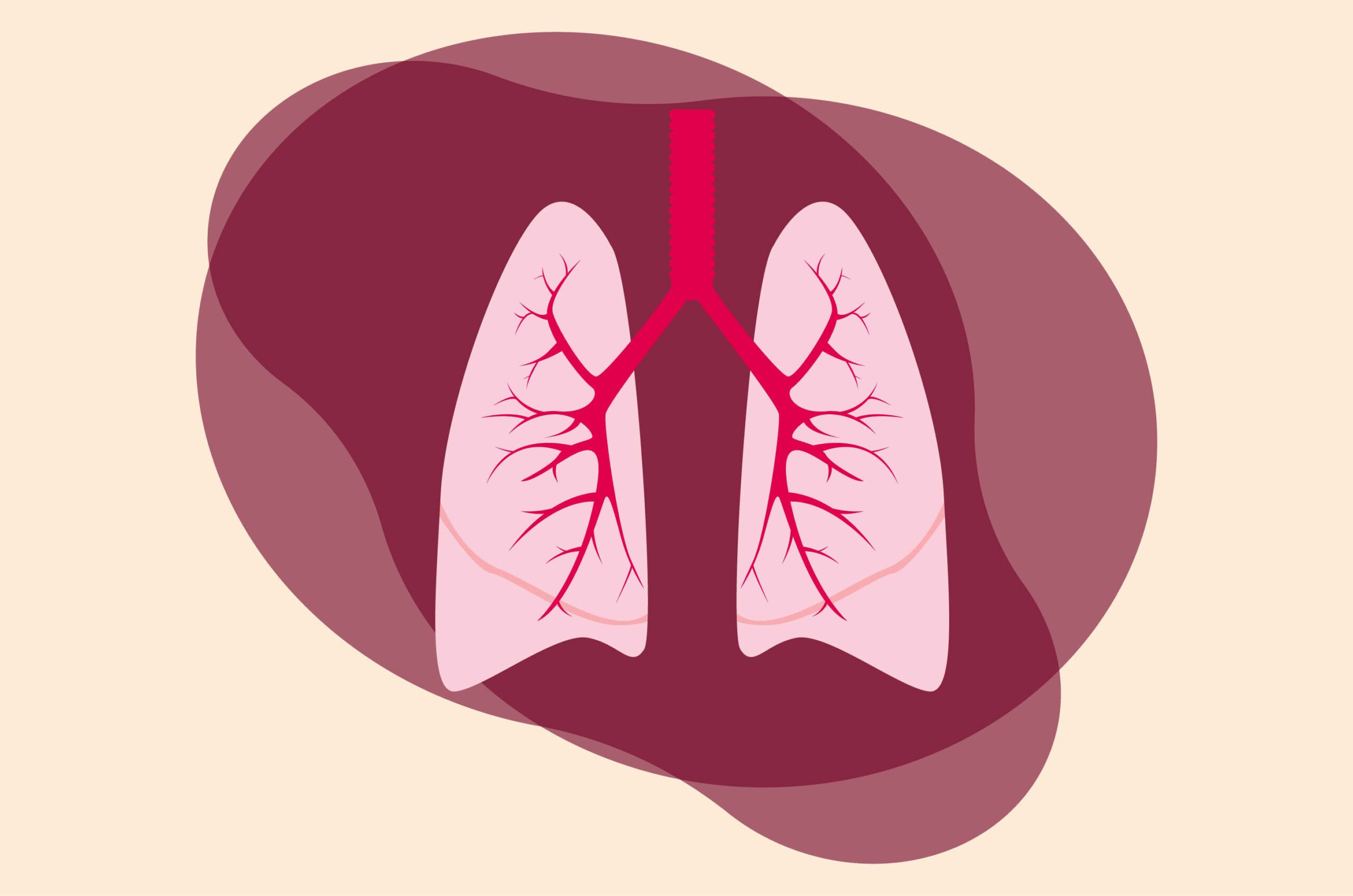 pneumonia
