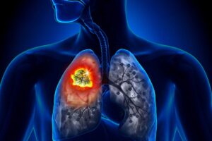 penyakit kanker paru