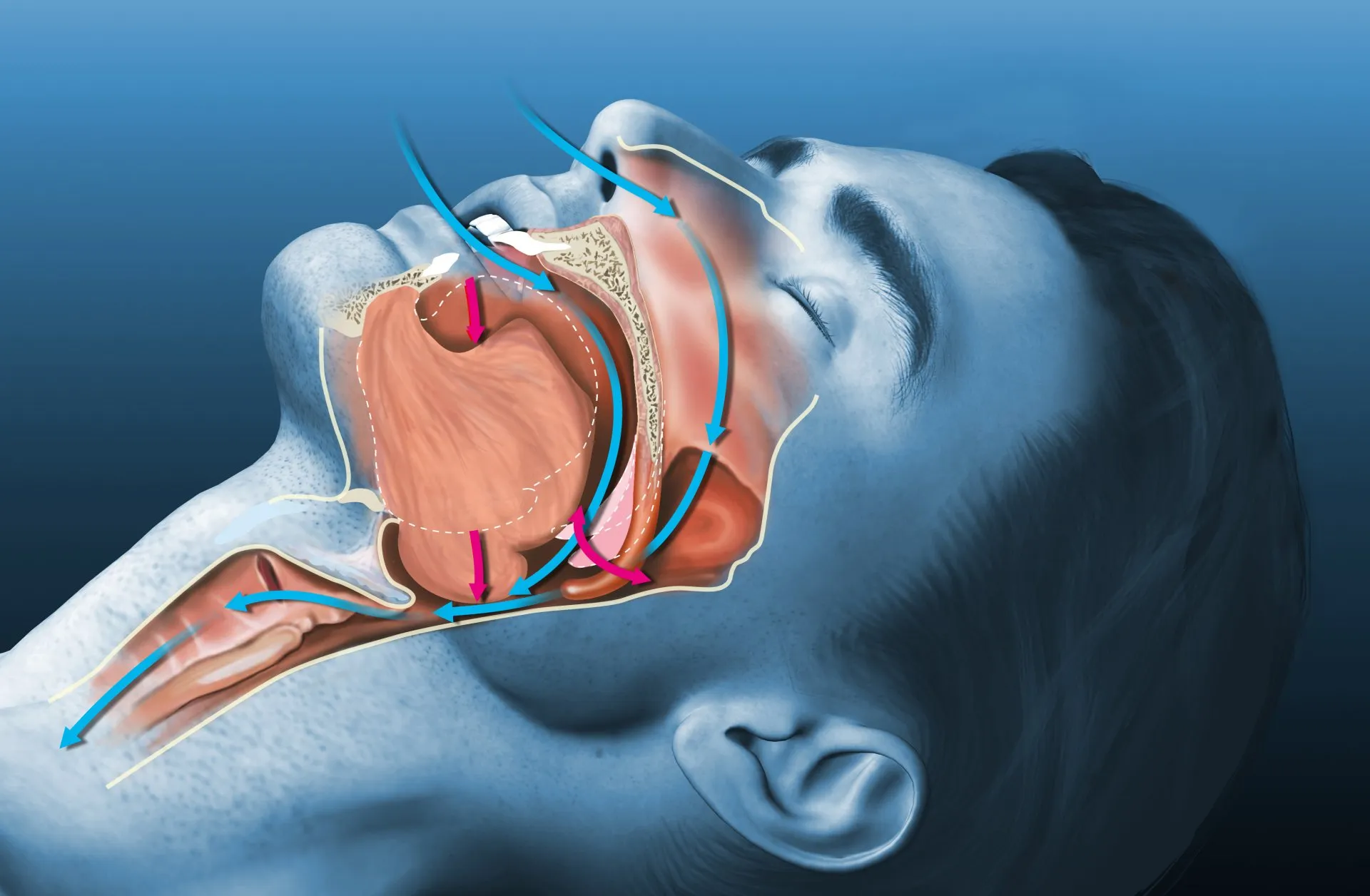 sleep apnea