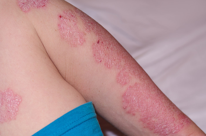 penyakit psoriasis