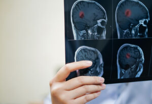 penyakit kanker otak