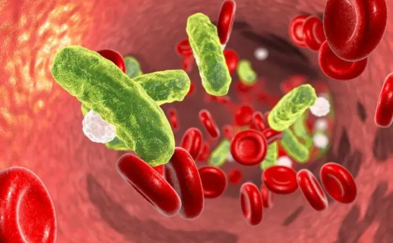 sepsis