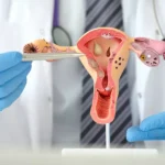 penyakit PCOS