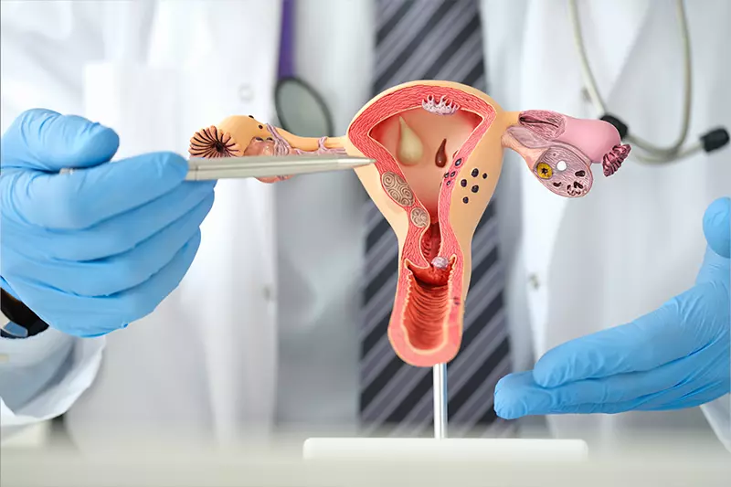penyakit PCOS