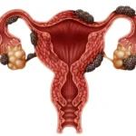 endometriosis