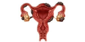 endometriosis