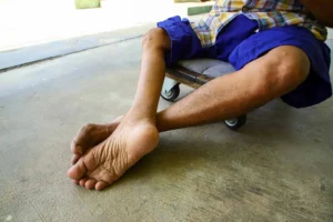 polio