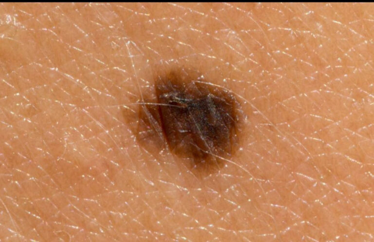 Melanoma